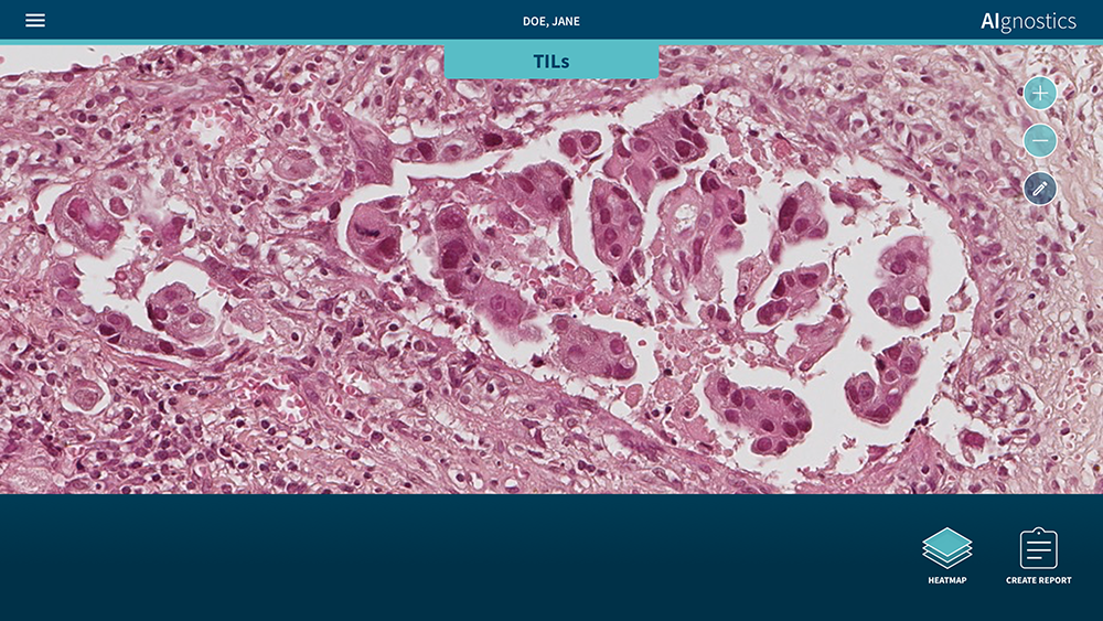 Bestimmung von Tumor-infiltirerenden Lymphozyten (TILs) durch erklärbare KI-Technologie. Histologische Präparierung eines Brustkrebskarzinoms.