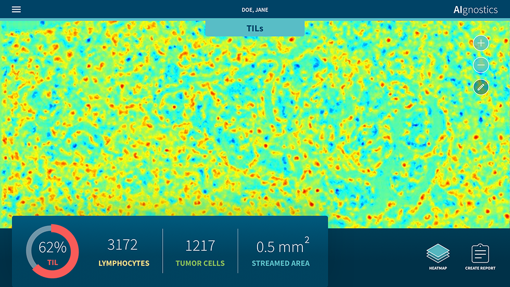 Das Ergebnis des KI-Verfahrens zeigt eine sogenannte Heatmap, die die TiLs in rot markiert. Sonstiges Gewebe/Zellen: blau und grün.